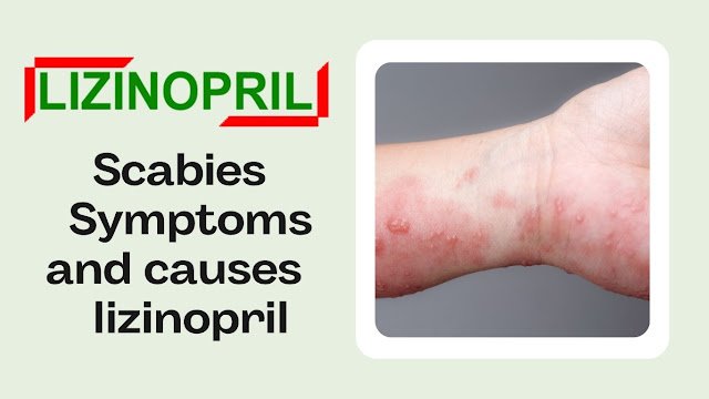 Scabies Symptoms and causes - lizinopril
